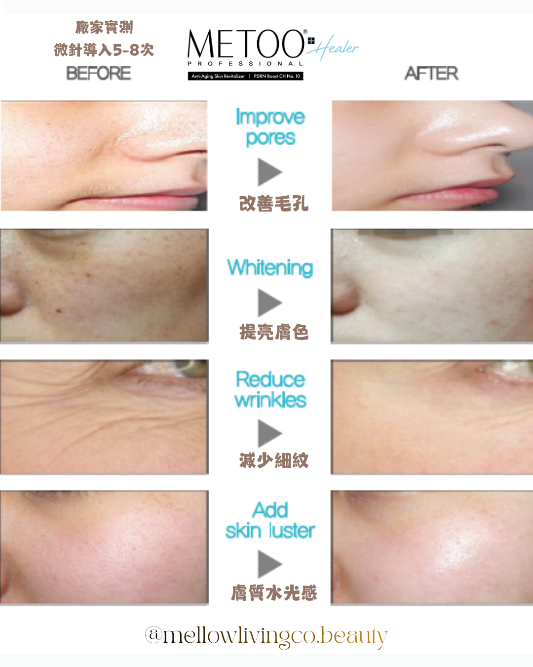 METOO Healer PDRN Boost CH 水光導入