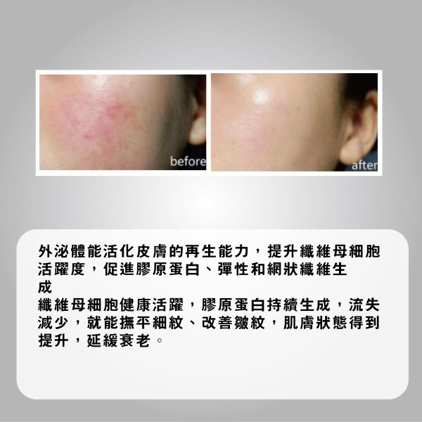 EXOXEN 外泌體細胞再生療程