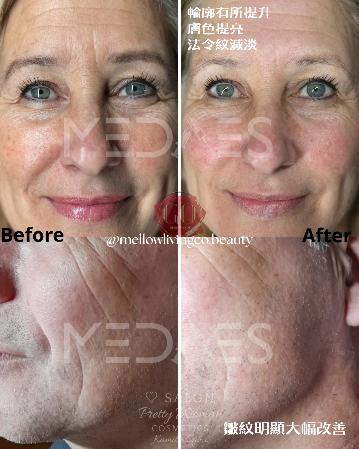 biopen T6 小電波 三合一專業美容儀