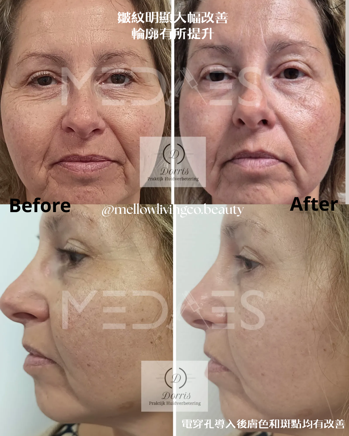 biopen T6 小電波 三合一專業美容儀